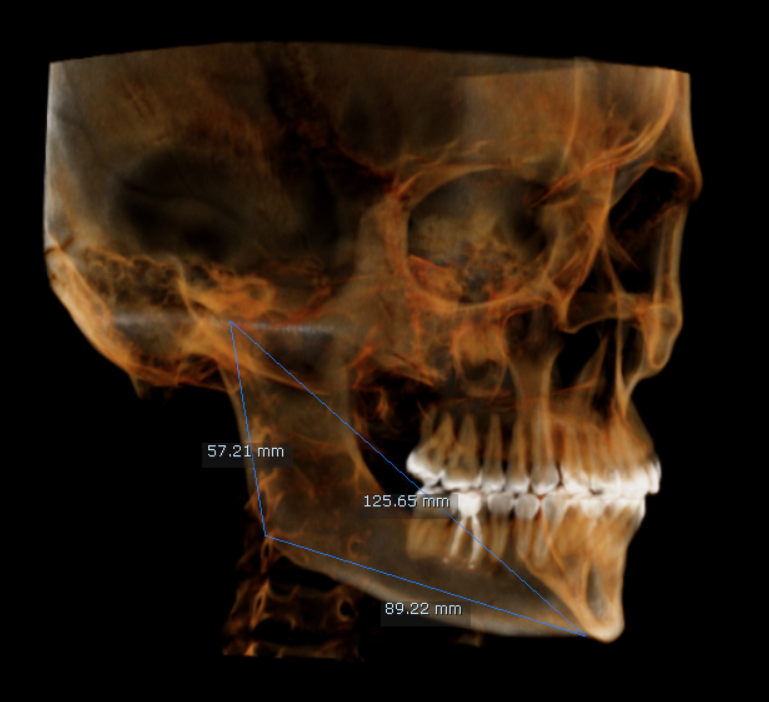 CR-SIMETRIA MANDIBULAR DERECHA