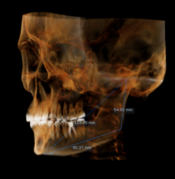 CR-SIMETRIA MANDIBULAR IZQUIERDA