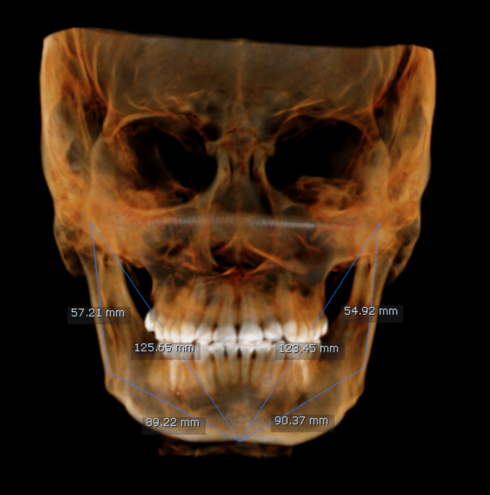 CR-SIMETRIA MANDIBULAR