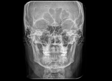 antero-posterior02