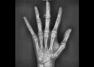 carpal02