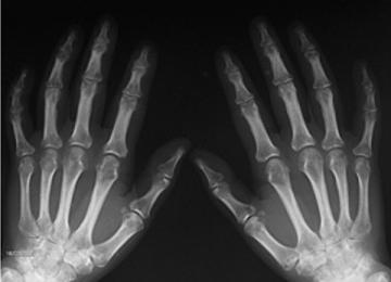 carpal03