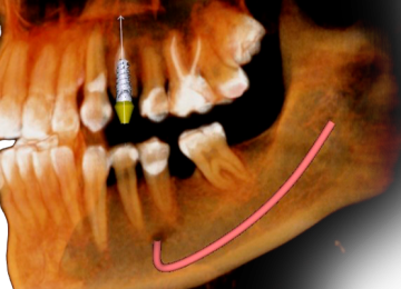 conebeammaxilarsuperior01