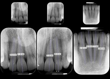 periapicalmedida01