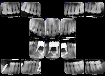 periapicalmedida02
