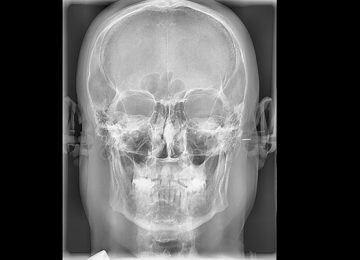 postero-anterior_02