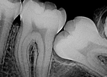 rperiapical03